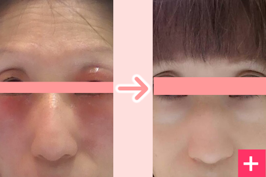 Before After：メイクかぶれ