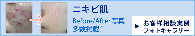 ニキビ肌 Before/After写真多数掲載！お客様相談実例フォトギャラリー