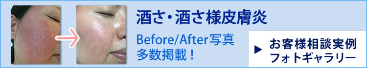 酒さ・酒さ様皮膚炎 Before/After写真多数掲載！お客様相談実例フォトギャラリー