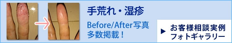 手荒れ・湿疹 Before/After写真多数掲載！お客様相談実例フォトギャラリー