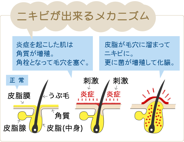 ニキビの出切るメカニズム